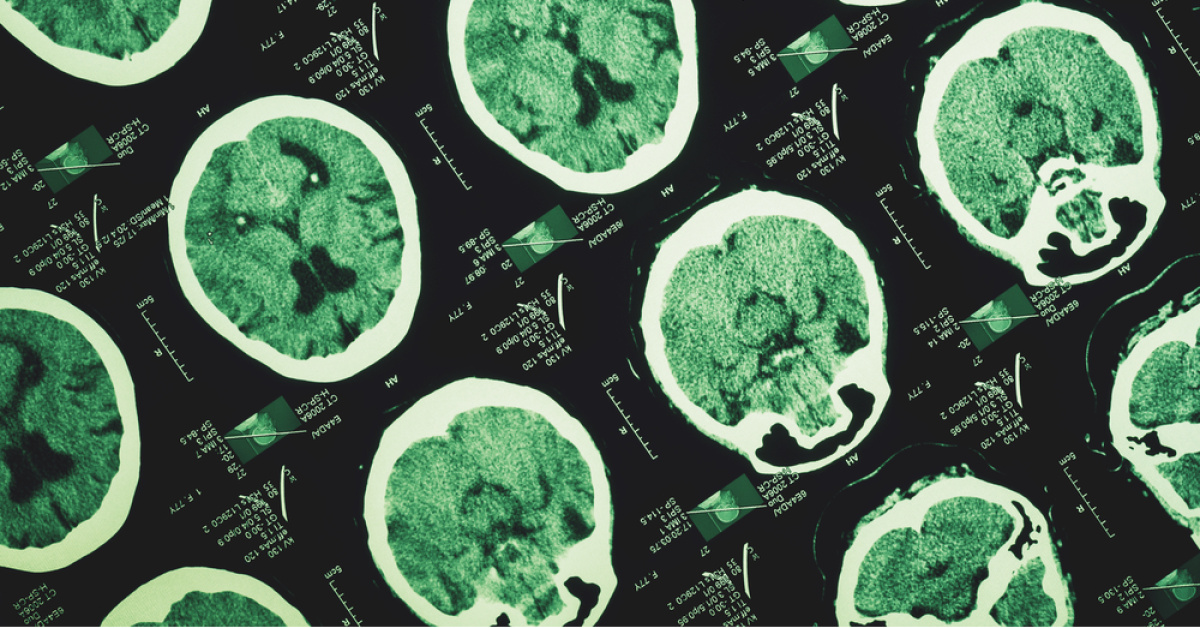 She thought she was fainting from fatigue... but the truth was that it was a vascular malformation in the brain